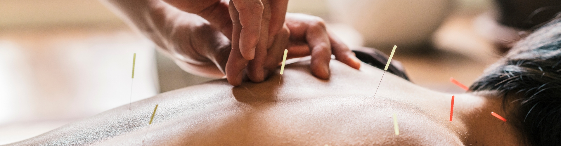 Acupuncture