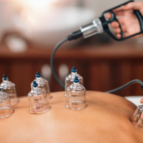 cupping-therapy-Mediways-Physiotherapy-Brampton-ON