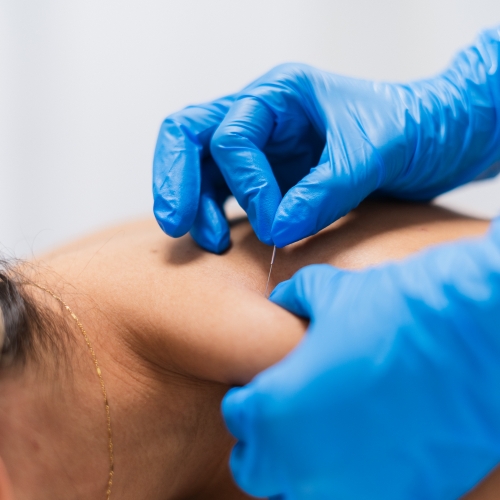 dry-needling-Mediways-Physiotherapy-Brampton-ON